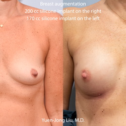 Breast Cosmetic