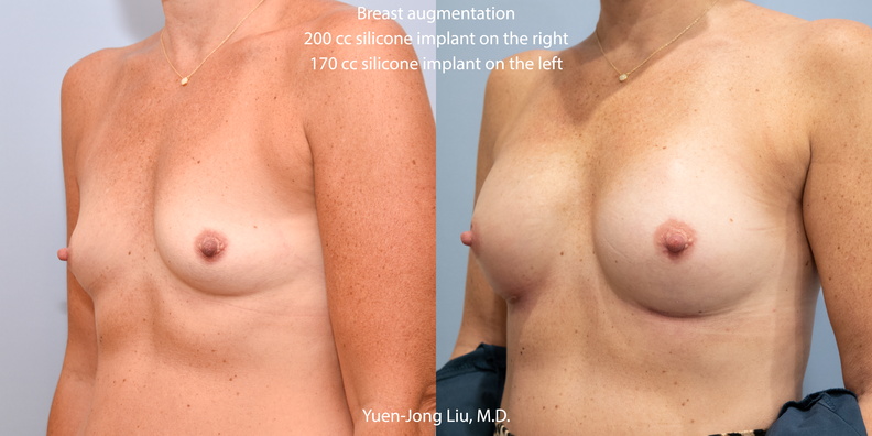 breast-aug-obl.jpg