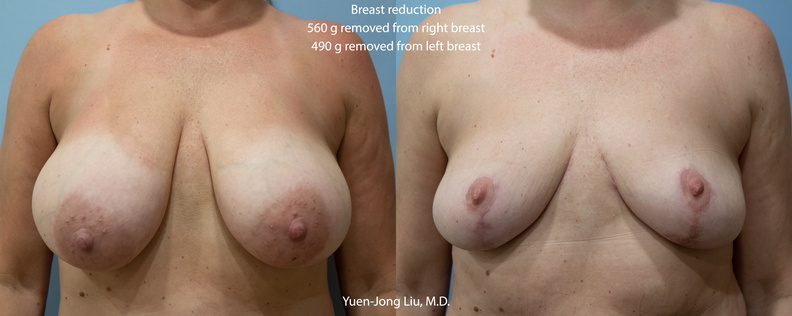 breast-reduction-ant.jpg