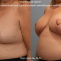 Oncoplastic Breast Reconstruction