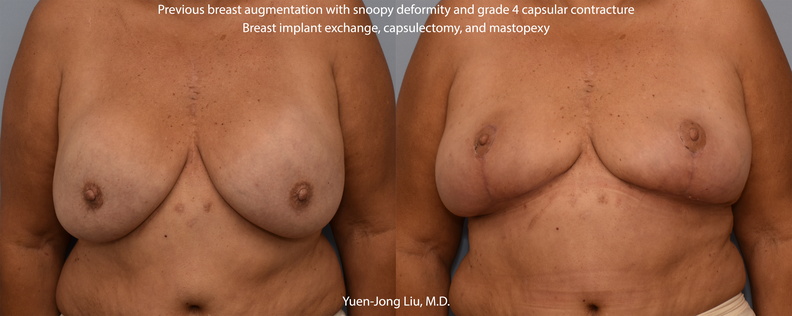 Breast Implant Exchange and Mastopexy