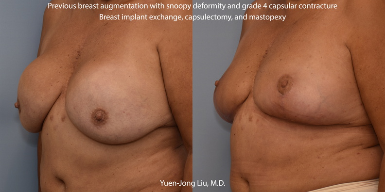 Breast Implant Exchange and Mastopexy