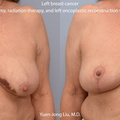 Oncoplastic Breast Reconstruction