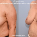 Oncoplastic Breast Reconstruction