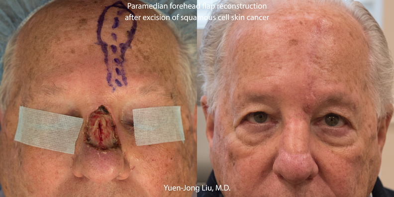 paramedian forehead flap before and after