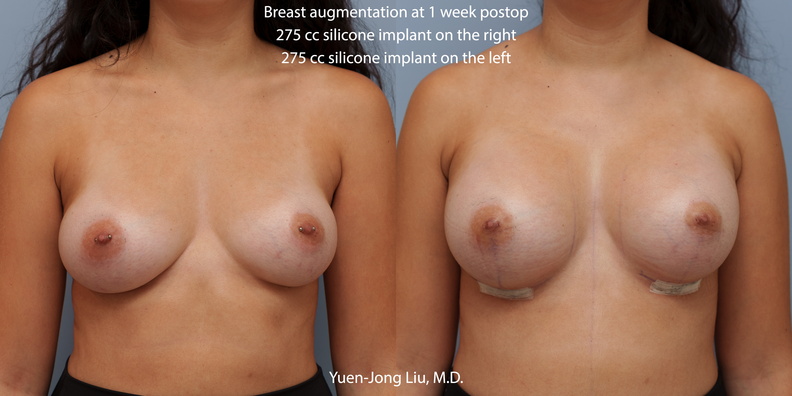 breast-augmentation-ant.jpg
