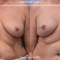 Breast Reconstruction with Silicone Implants