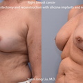 Breast Reconstruction with Silicone Implants